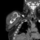 Pathological fracture of humerus: CT - Computed tomography